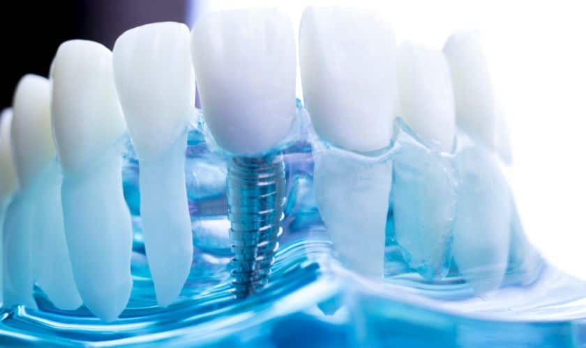 Same Day Dental Implants: A Quick and Convenient Solution